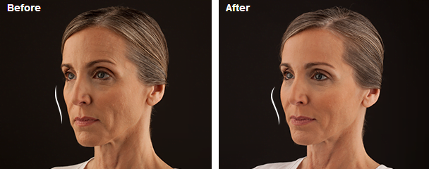 Before and after facial aesthetic transformation comparison.
