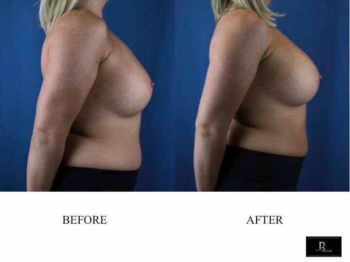 How can I increase upper pole projection of my breasts?
