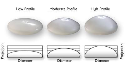 Considering Breast Implant Removal?