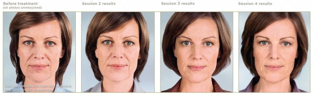 Comparison of facial treatment progress over time.