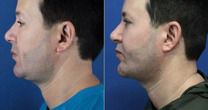 Before and after profile comparison of a man