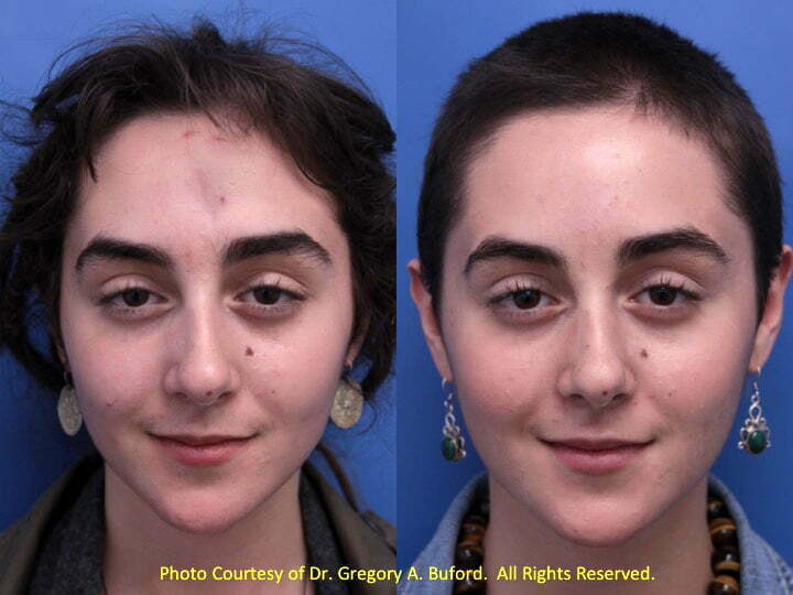 Facial Scar Surgery 119