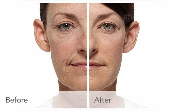 Before and after Belotero Balance treatment results.