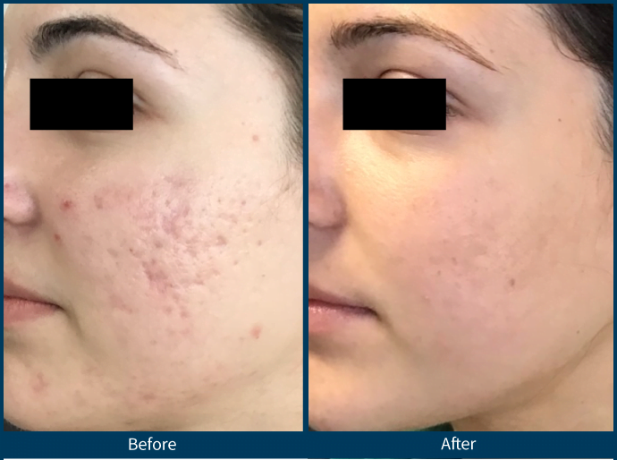 skinpen microneedling lone tree