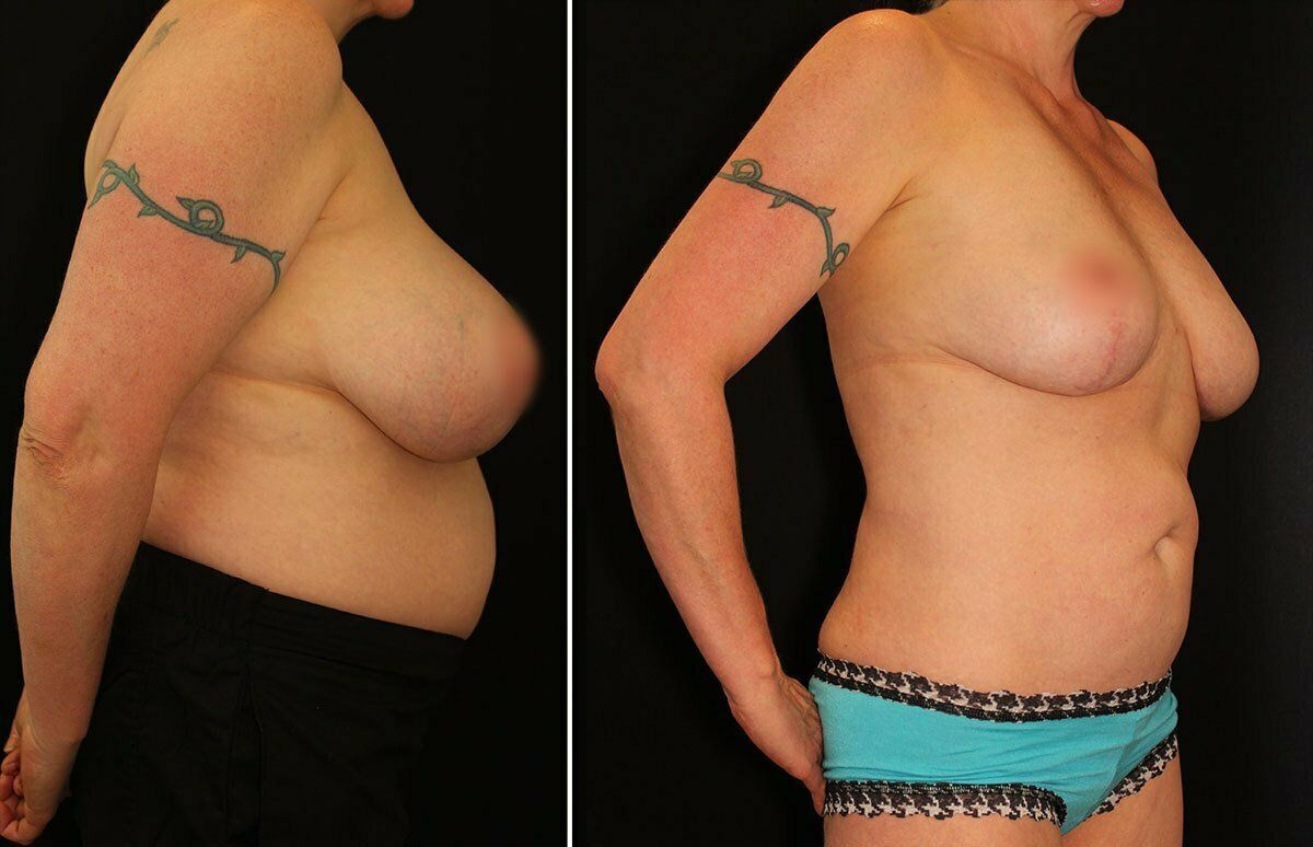 Buford Fat Transfer Patient A Before and After