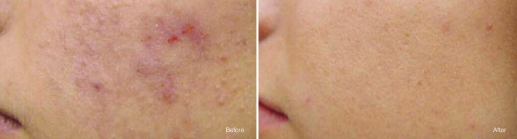 Skin improvement before and after treatment comparison.