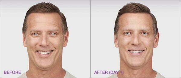 Before and after facial treatment results comparison.