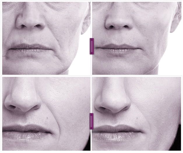 Before and after skin treatment comparison images.