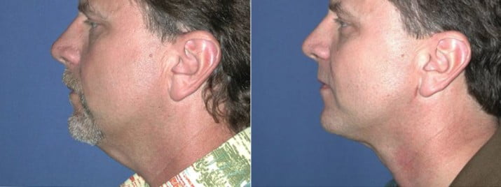 neck-liposuction-1c-715x268