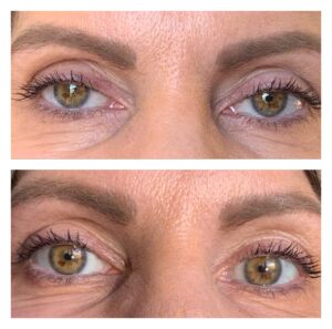 Patient's eyes shown first with sagging lids that cover upper iris, and after Upneeq with lids at the top of the iris.