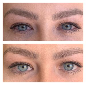 Patient shown before and after Upneeq; in the "before" image her lids mildly cover the upper portion of the iris, and in the after photo, her eyes appear more open and brighter.