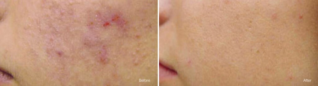 Before and after Vivace for acne in the cheek area ; before image shows a breakout, and after image shows clear, smooth skin